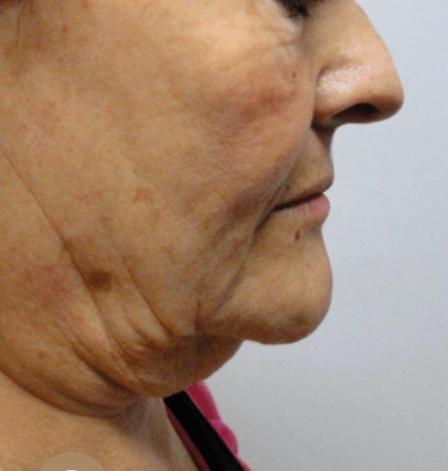 Antes - Cabeça e pescoço